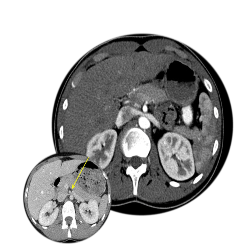 Syndrome de NutCracker Uniteva